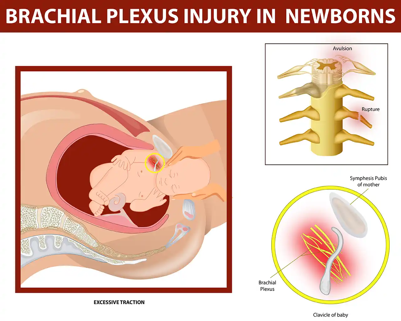 Navigating the Complexity of Brachial Plexus Birth Injuries: What You Need to Know
