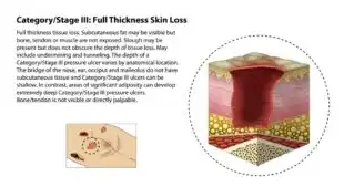 Stage III Bedsores