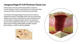Stage IV Bedsores