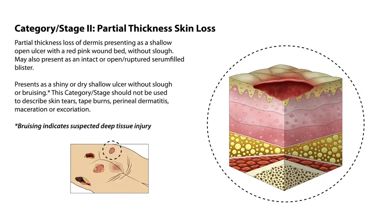 Category/Sage 2: Partial Thickness Skin Loss