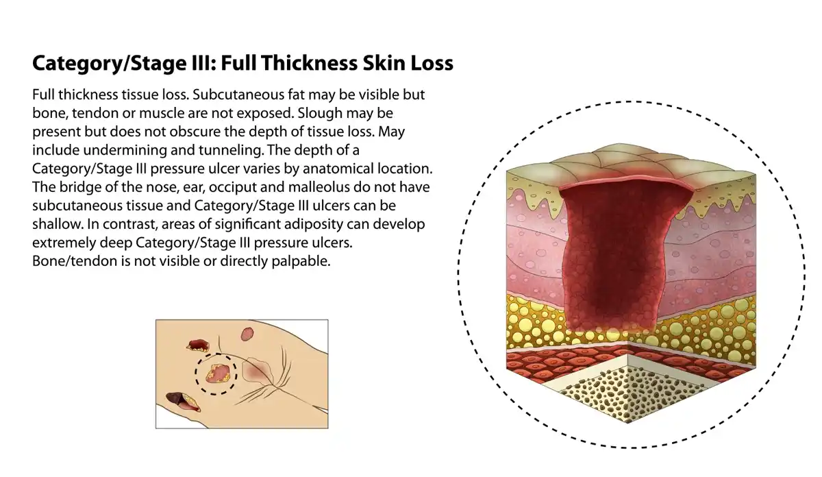 Category/Sage 3: Full Thickness Skin Loss